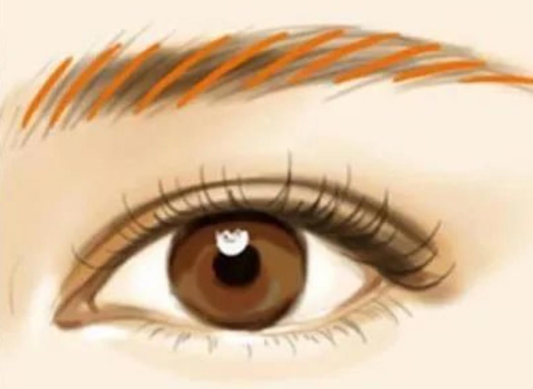 ¿La extracción de microblading láser (eliminación de tatuajes de cejas) dejará cicatrices?