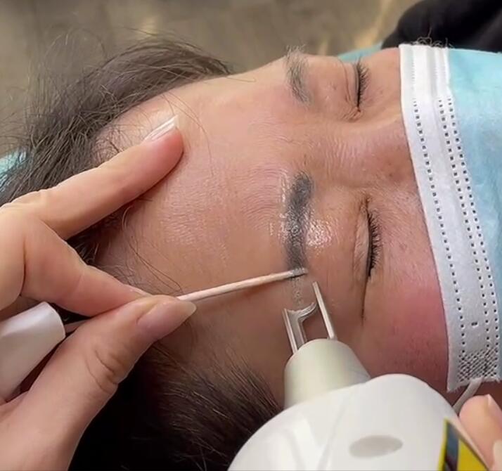¿A qué debemos prestar atención antes y después de la extracción del tatuaje de cejas láser?