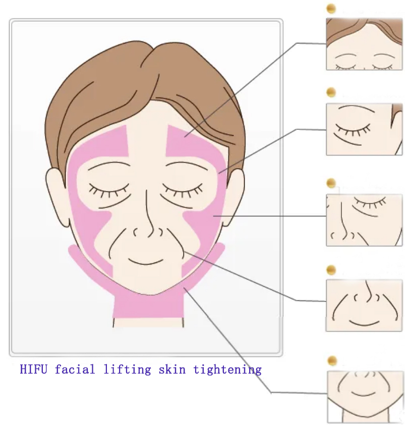 ¿Cómo dibujar líneas de tratamiento antes del tratamiento con levantamiento facial de HIFU para evitar el daño de la piel?