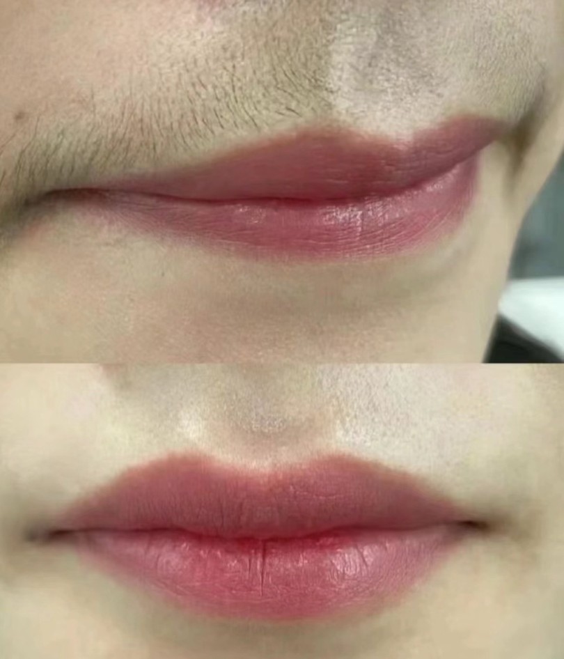 Professional Laser Hair Removal Equipment
